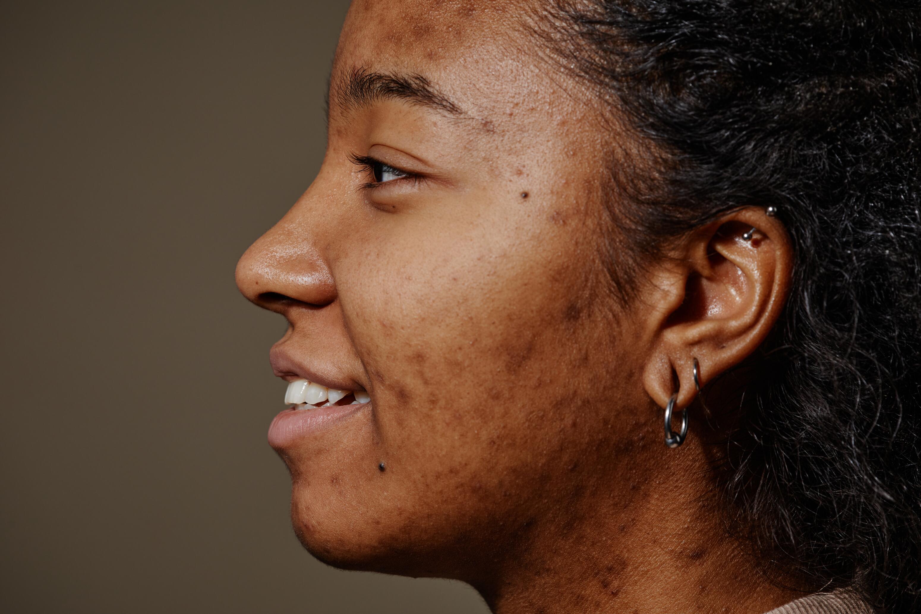 Post-inflammatory hyperpigmentation